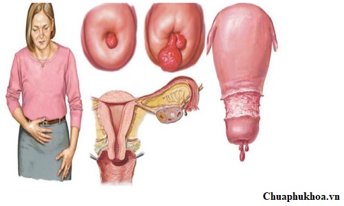 Triệu chứng polyp cổ tử cung